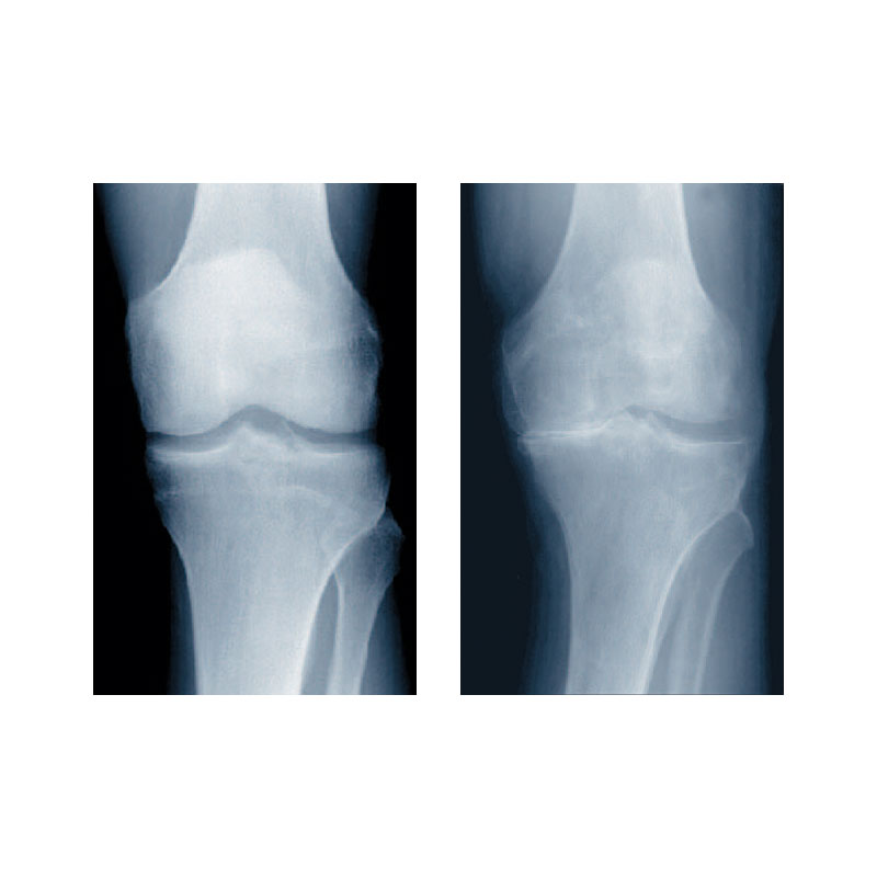 Arthrose im Kniegelenk Röntgenbild