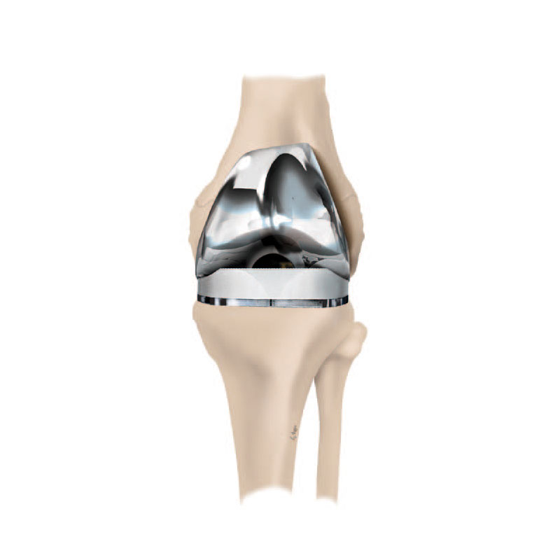 Implantiertes künstliches Kniegelenk (Vorderansicht)